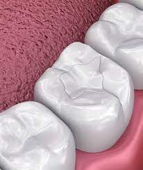 شیرین گلیکانلوی میلان -Shirin Glikanlouye Milan-Dental Filling- پرکردن دندان